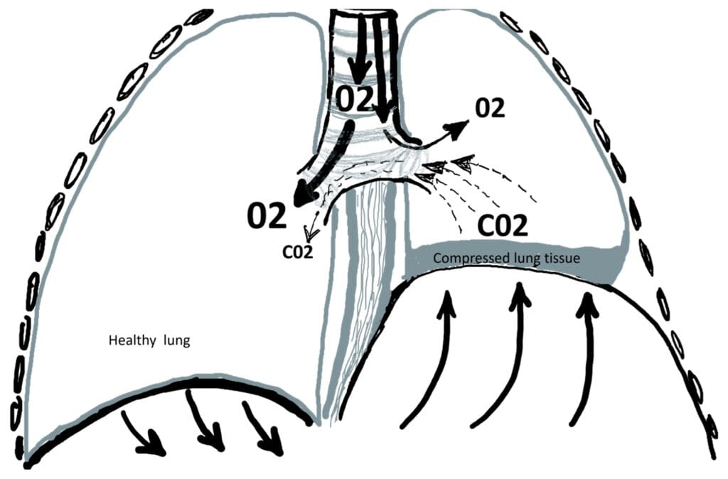 Illustration comparing a normally lowered diaphragm with an elevated paralyzed diaphragm compressing the lung